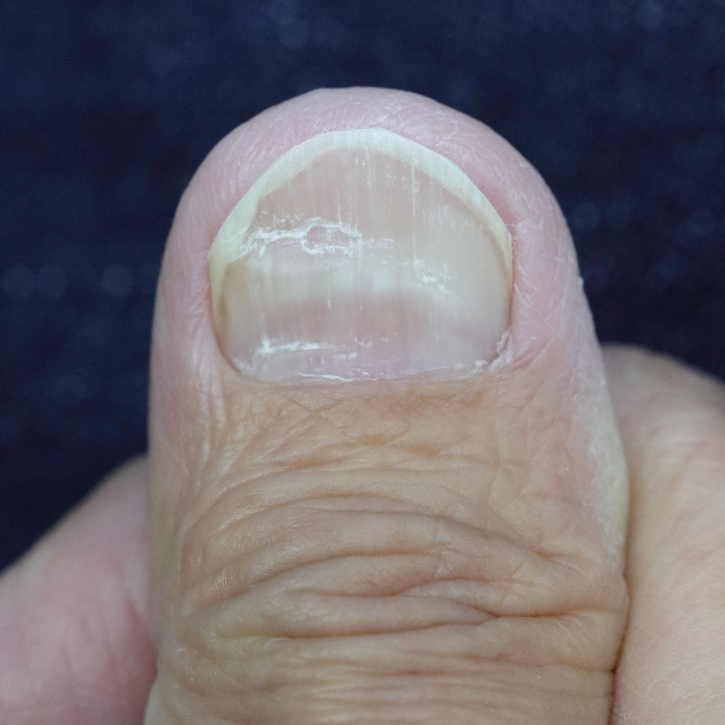 腰椎圧迫骨折に起因する右手親指の爪の異変　2018